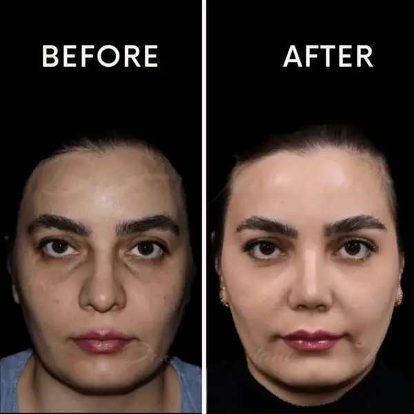 نمونه عمل بینی گوشتی در تهران دکتر جاودانی