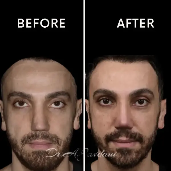 نمونه عمل بینی در تهران دکتر جاودانی