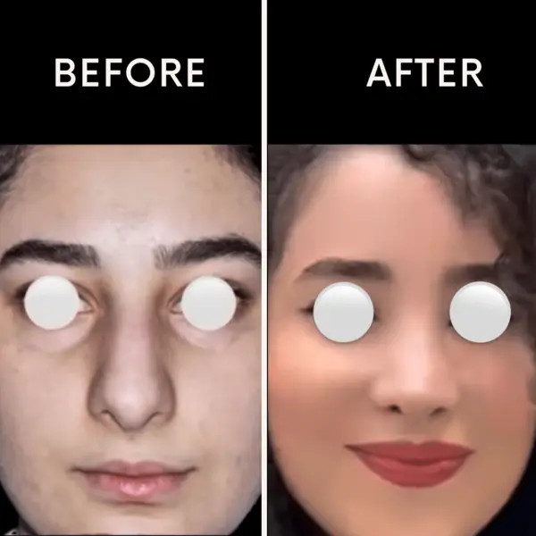 عکس عمل بینی در تهران دکتر شرفیان