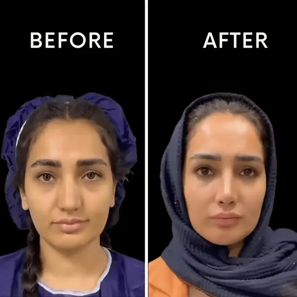 قبل و بعد عمل بینی دکتر پوریوسف