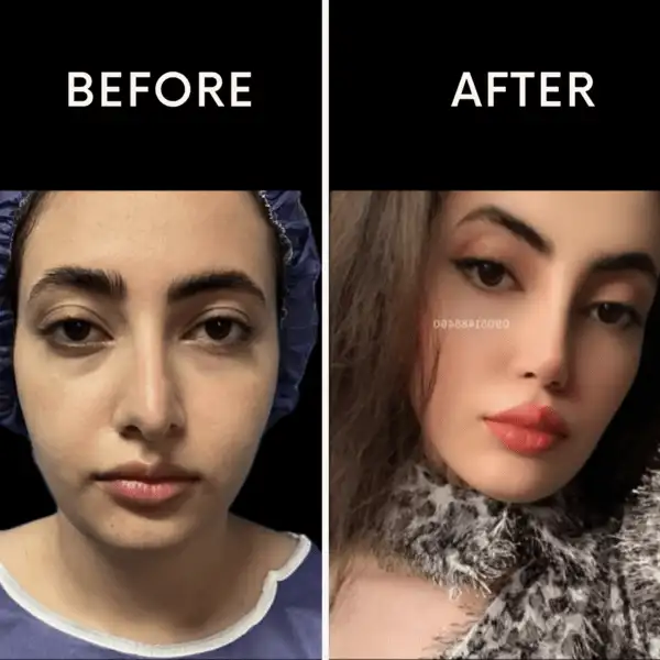 نمونه عمل زیبایی بینی تهران دکتر مقتدر
