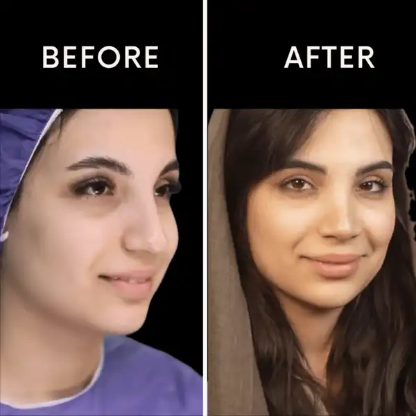 قبل و بعد عمل بینی دکتر ملکی
