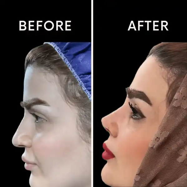 نمونه عمل بینی در تهران دکتر ملکی