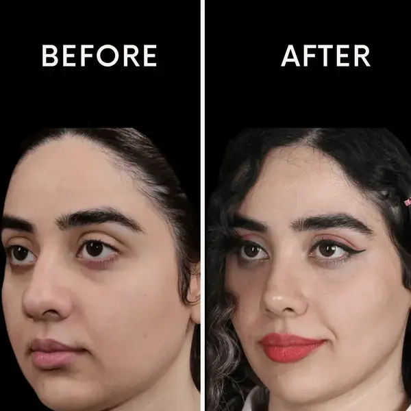 نمونه کار دکتر امین آمالی بهترین جراح بینی طبیعی در تهران